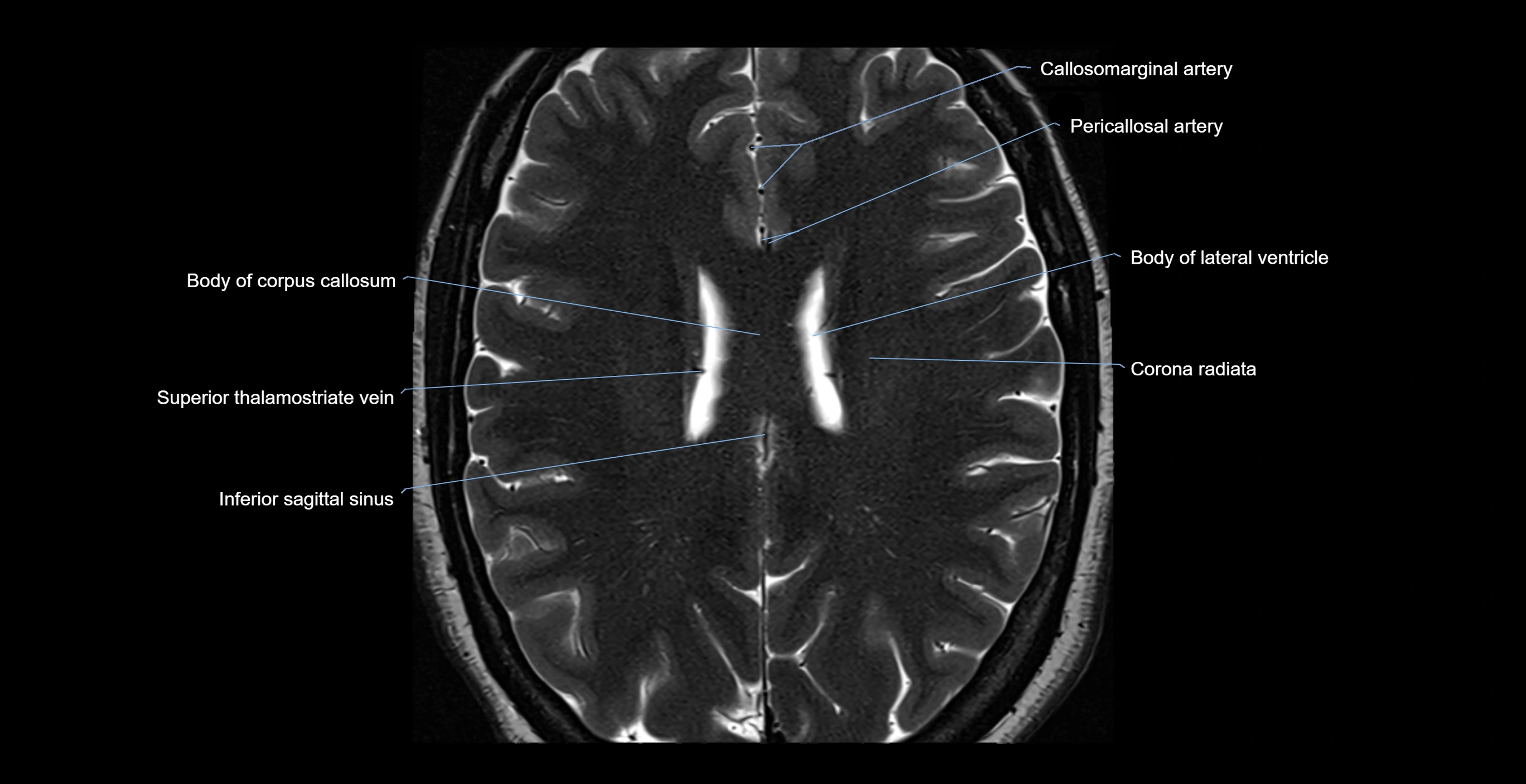 brain axial anatomy 3T MRI images -img-17001-00042.webp